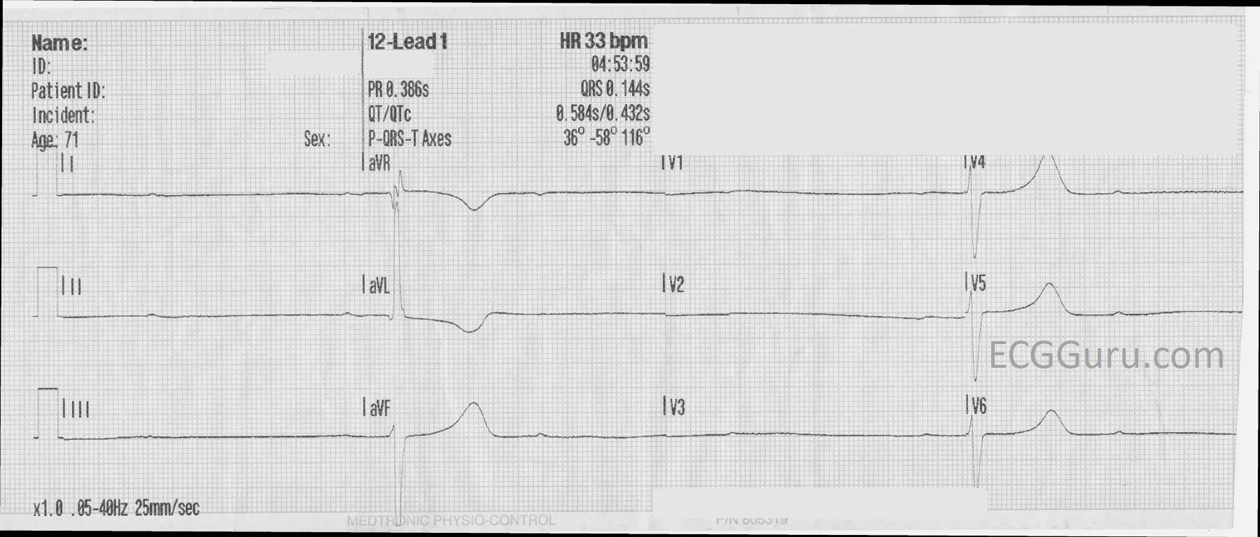 Instructors Collection Ecg High Grade Av Block With Bradycardia Ecg